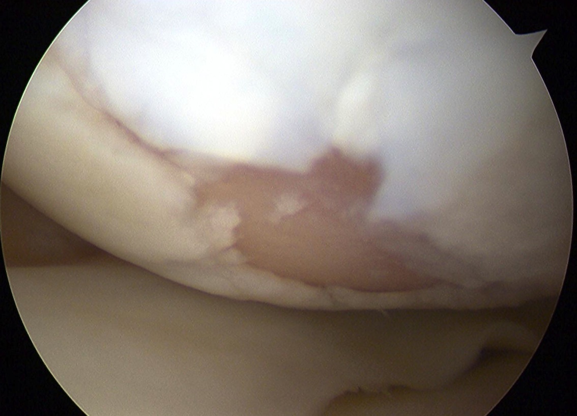 ICRS Grade 4 Chondral Lesion